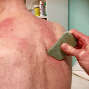 chinesische Behandlung Gua Sha